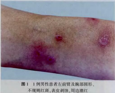 1509160189573656.png ▲吸冰毒受损的皮肤.png